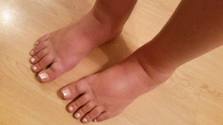 Prevent Swollen feet legs and hands 